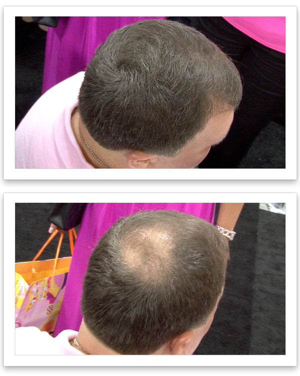 Before and after image of a man with short straight brown hair with a bald spot on his crown