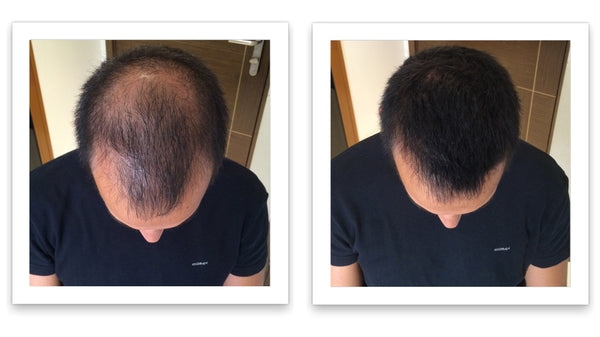 Before and after image of a man with short straight black hair who has a bald spot on his crown