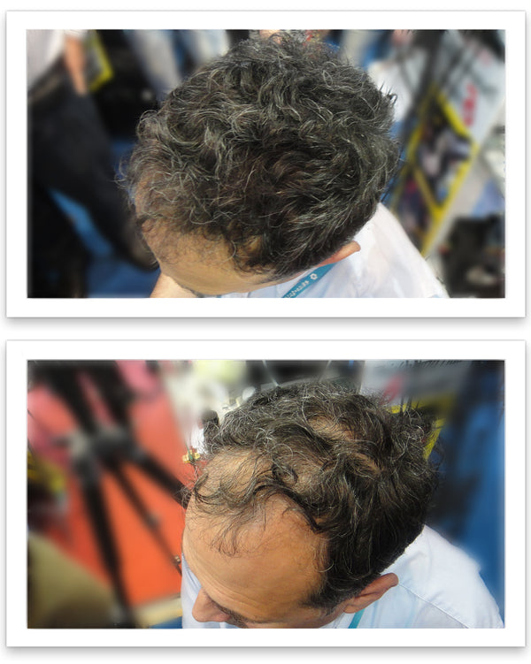 Before and after image of a man with short curly black and gray hair who has a receding hair line and a bald spot on his crown