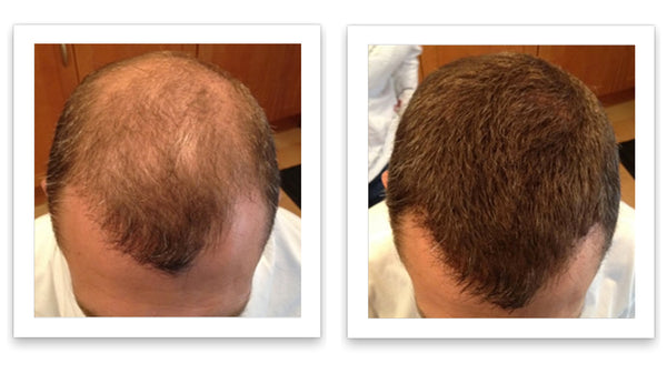 Before and after image of a man with thin brown hair on the crown and mid-scalp region