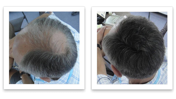 Before and after image of a man with a short straight black hair and a bald spot on his crown