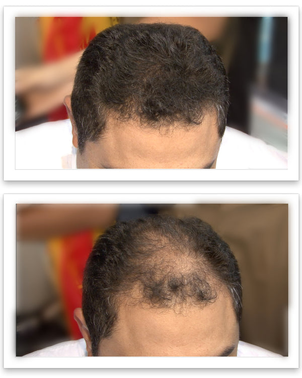 Before and after image of a man with short curly black hair with a bald spot on the crown and front scalp
