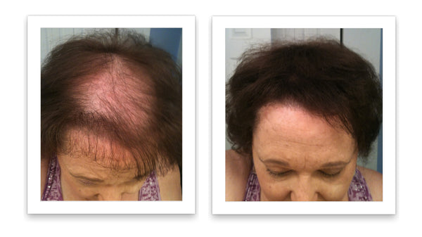 Before and after image of a woman with straight dark brown hair with a bald spot that extends from the frontal scalp to the crown